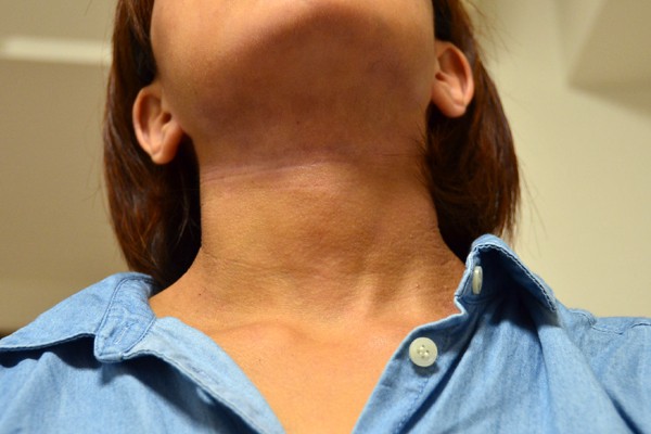 施術で皮膚の血行が良くなることにより改善してきた首のアトピー