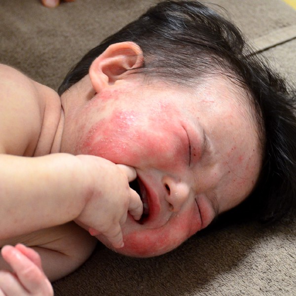 乳児湿疹からの顔のアトピー