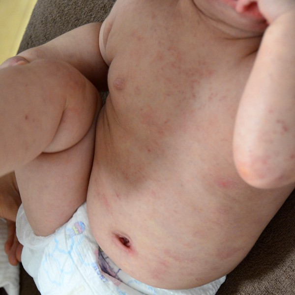 乳児湿疹からのアトピー