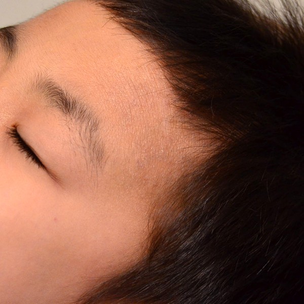 脱ステ、脱保湿、施術で改善してきた子供の顔のアトピー