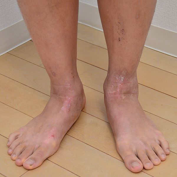 脱保湿と施術で改善してきた足のアトピー