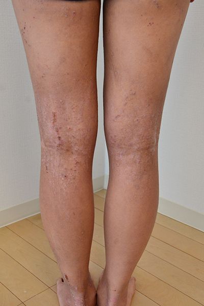 脱保湿と施術で改善してきた足のアトピー