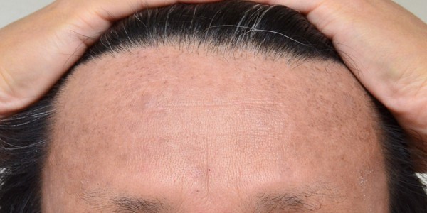 脱保湿と施術で改善してきた顔のアトピー