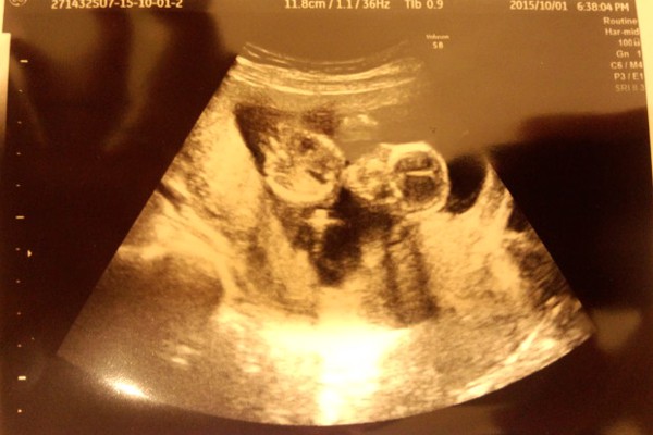 不妊整体　胎児　妊娠14週